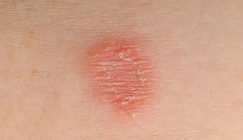 人得貓癬多久會好？完整治療時間與復原指南