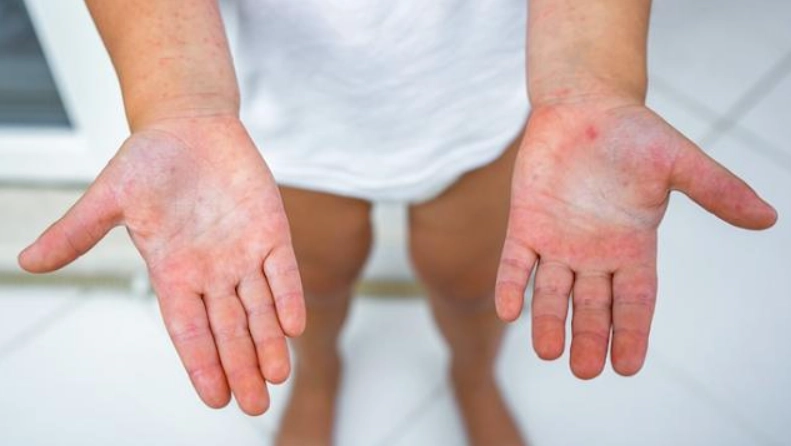 腸病毒 傳染 狗