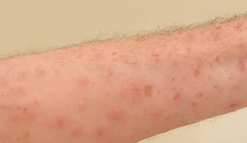輕微疥瘡初期症狀全解析：如何及早辨識與有效處理