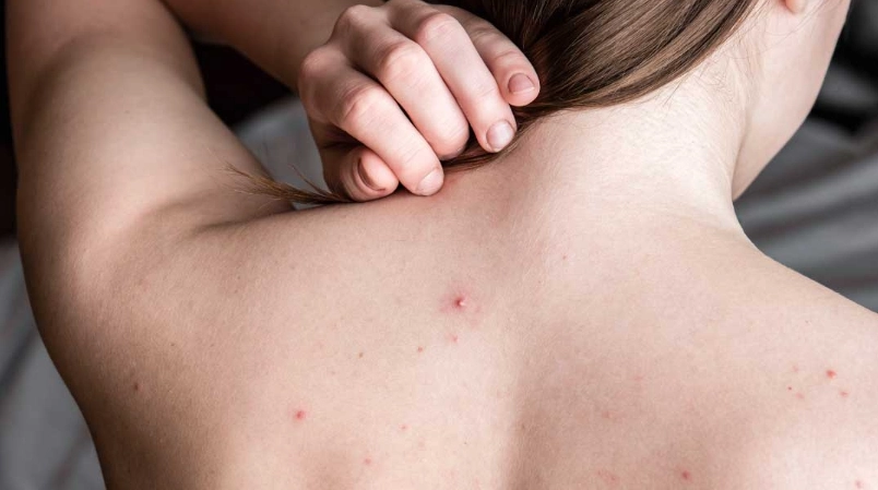 輕微疥瘡初期症狀