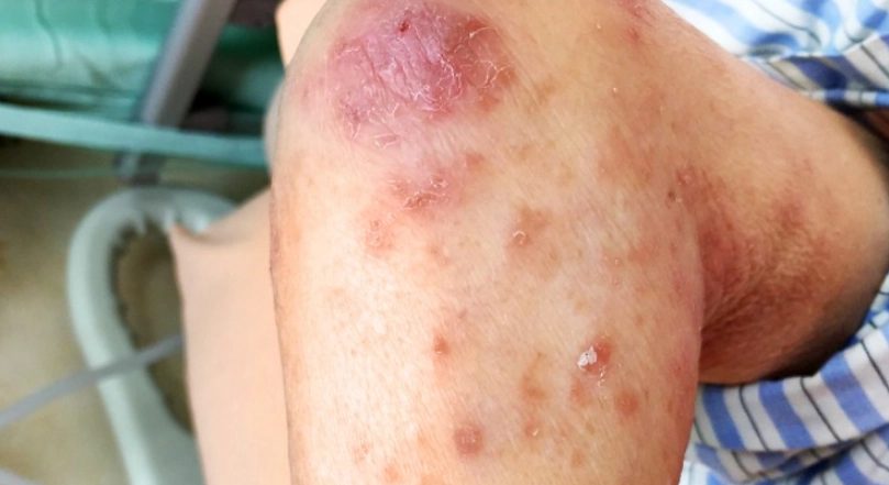 疥瘡治療要多久？皮膚科醫師詳解完整療程與止癢關鍵