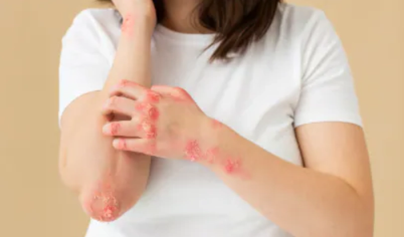 人感染貓癬怎麼辦？完整治療指南與預防心法