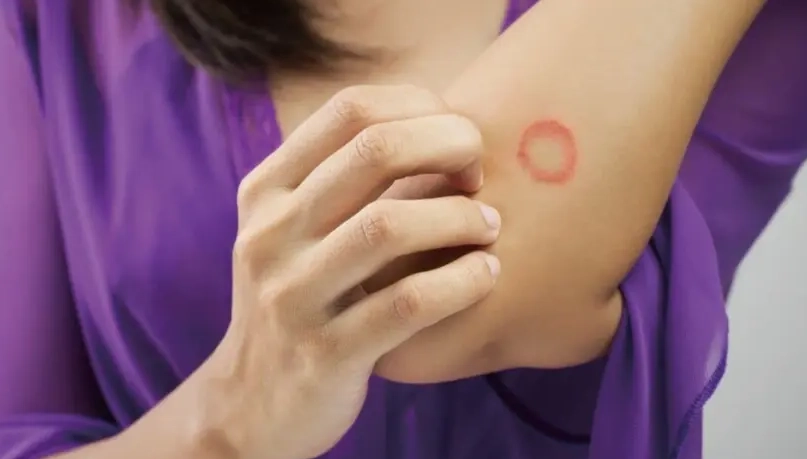 人得貓癬怎麼辦？完整症狀、治療與預防指南