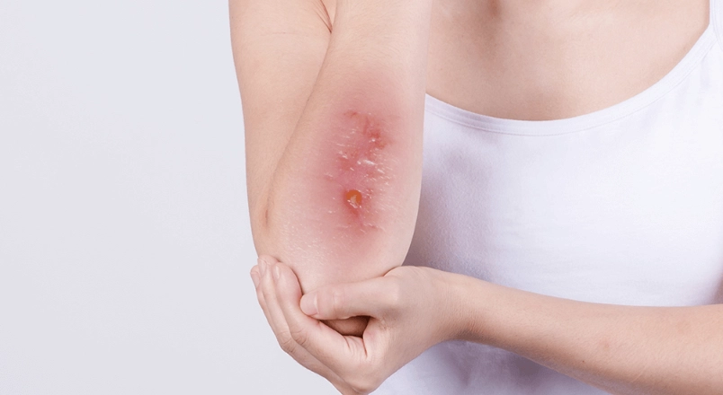 貓瘟傳染人症狀