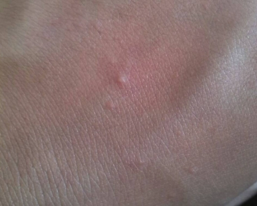 一次搞懂疥瘡與濕疹的關鍵差異：症狀、成因與治療全解析