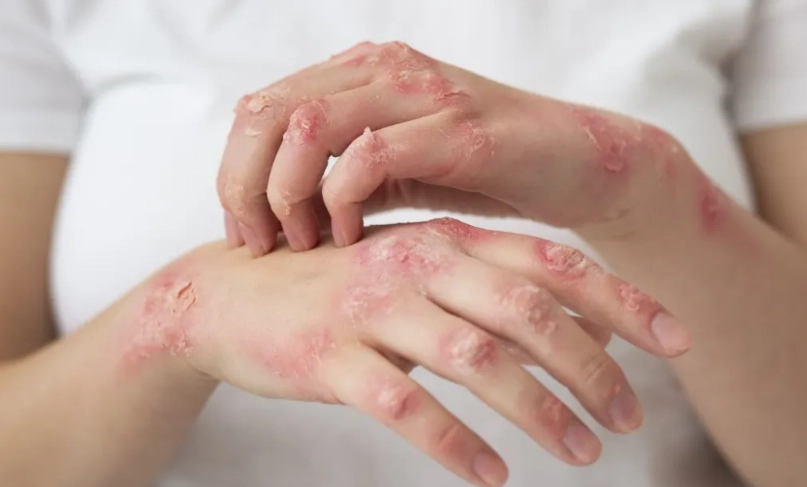 改善濕疹的實用指南：從日常護理到飲食調整的全面策略
