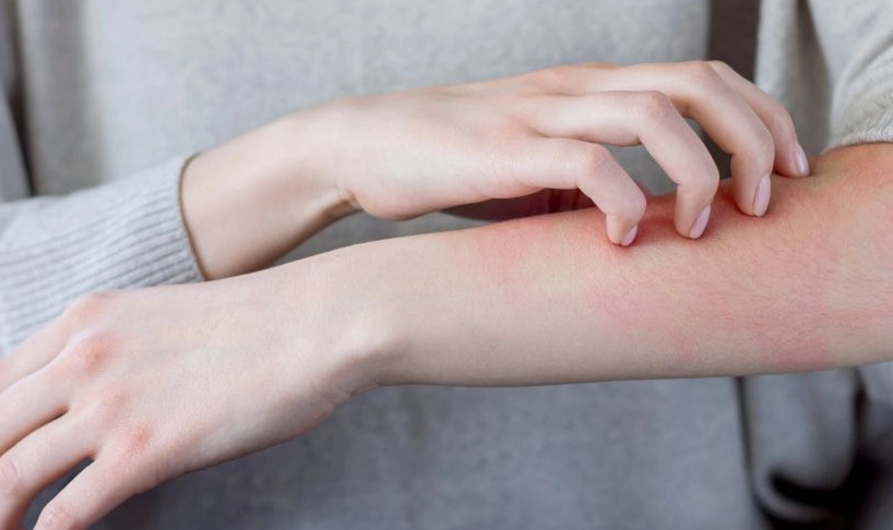 如何知道疥瘡好了？痊癒的5個關鍵指標與避免復發指南