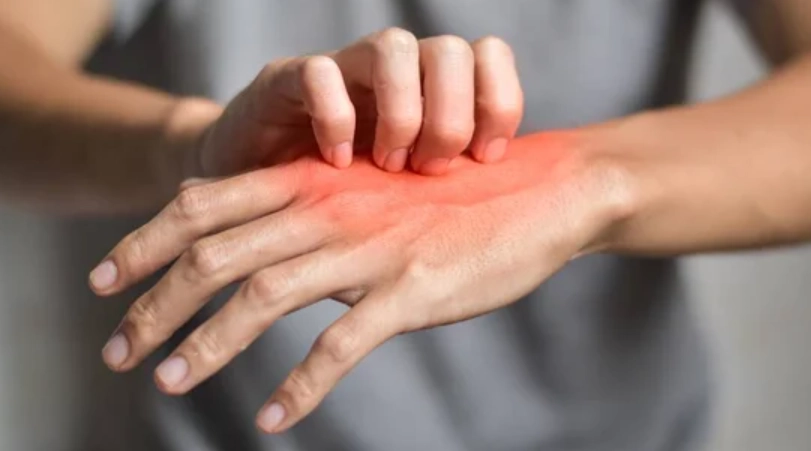 疥瘡初期洗澡指南：正確清潔與錯誤迷思一次解答