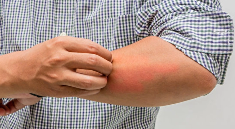 疥瘡可以洗澡嗎