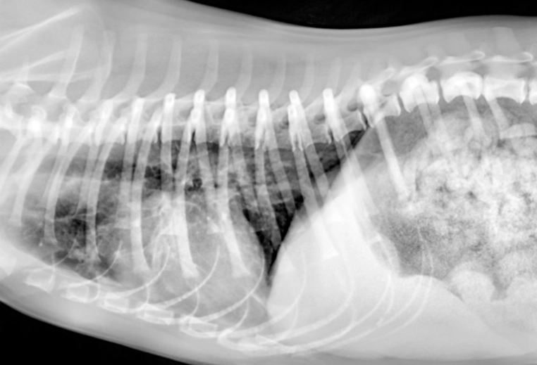 肺積水治療費用 肺積水治療費用