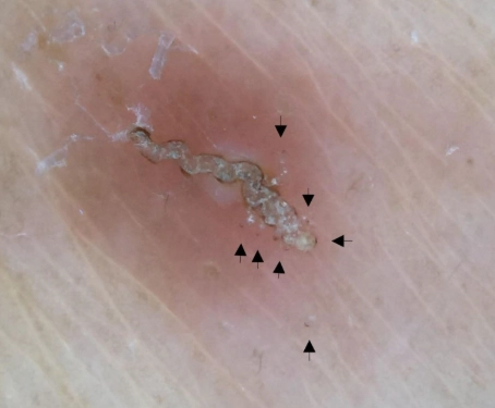 疥瘡治療