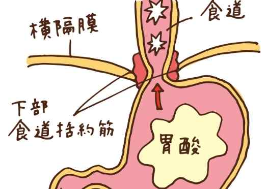 胃食道逆流自然療法