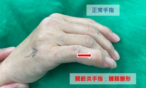 指間炎治療期間