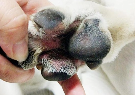 趾間炎腫瘤治療