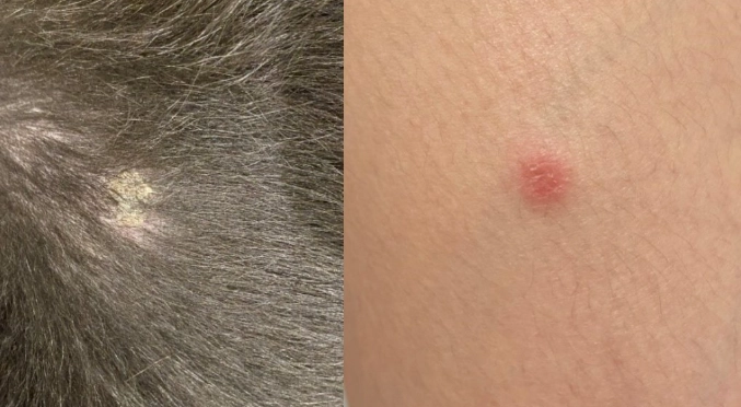 貓癬人傳人症狀