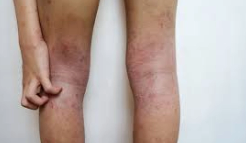 白木耳過敏測試