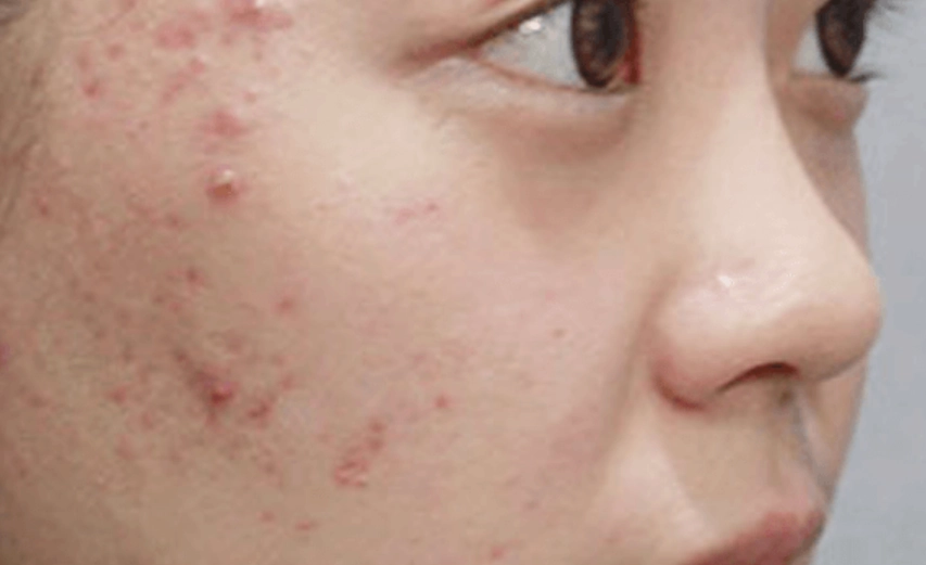 椰子油皮膚炎預防