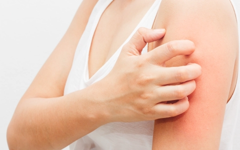 椰子油皮膚炎症狀