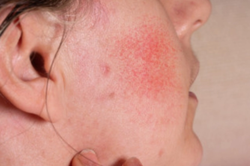 椰子油治療濕疹