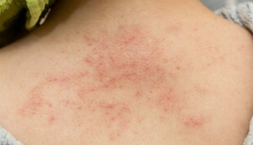 椰子油治療濕疹