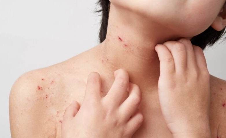 椰子油皮膚炎症狀