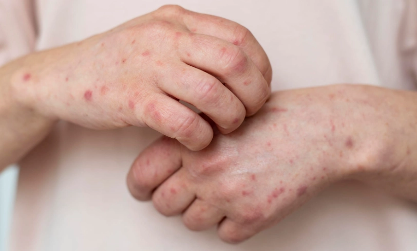 茶籽油治療濕疹